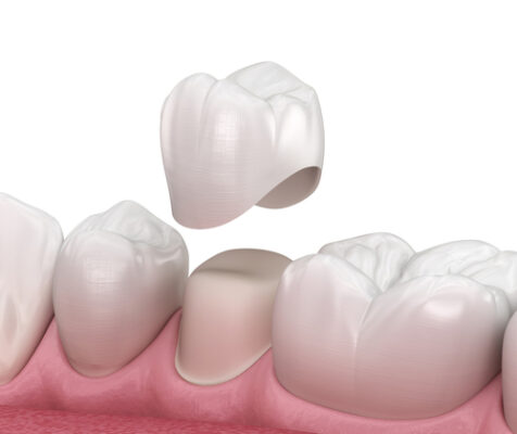 Dental-Crowns-in-Melbourne-FL-Designing-Smiles-Dr.-Victor-Apel