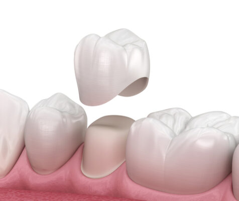 Dental-Crowns-in-Melbourne-FL-Diseño-Smiles-Dr.-Victor-Apel