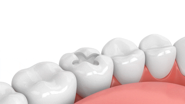 Extracciones Dentales en Melbourne, FL Diseño de Sonrisas Dr. Victor Apel