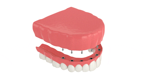 Implante-Dentaduras-en-Melbourne-FL-Diseño-Smiles-Dr.-Victor-Apel