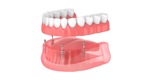 Implante-Dentaduras-en-Melbourne-FL-Diseño-Smiles-Dr.-Victor-Apel