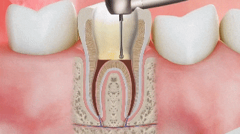 Endodoncias en Melbourne, FL Diseño Sonrisas Dr. Victor Apel