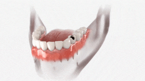Dental-Crowns-in-Melbourne-FL-Designing-Smiles-Dr.-Victor-Apel