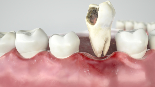 Extracciones Dentales en Melbourne, FL Diseño de Sonrisas Dr. Victor Apel