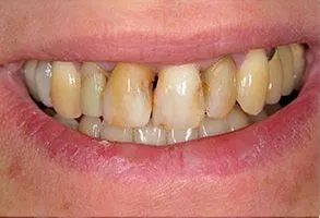 Designing Smiles Dentistry | Odontología Cosmética en Melbourne, FL | Dr. Victor Apel
