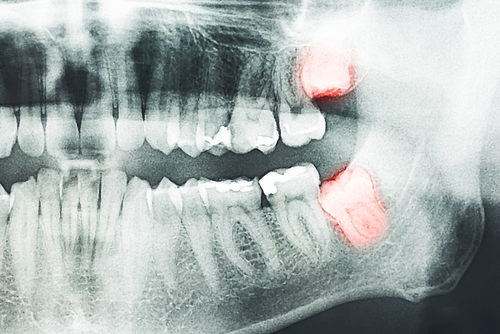 Wisdom Tooth Extraction: Modernizing Your Smile | Melbourne, FL