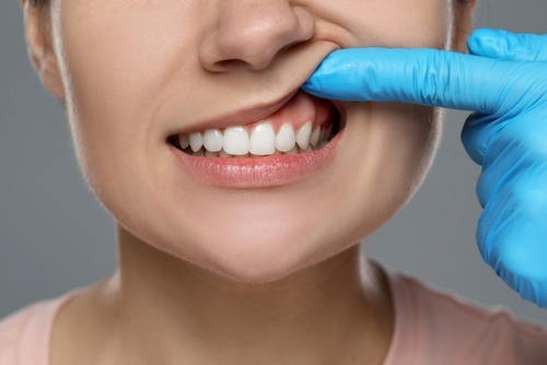 Signs of Gum Disease in Melbourne, FL | Periodontal Disease