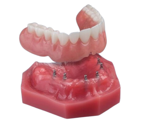 Mini Dentures in Melbourne, FL | Implant Dentures | Mini Implants