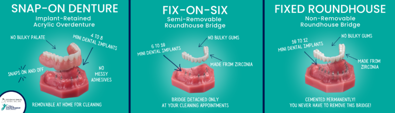 Mini prótesis dentales en Melbourne, FL | ¡Reserva una consulta gratuita!