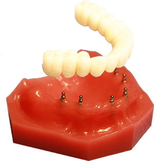 All-on-4 | Fix-on-Six in Melbourne FL | Mini Implant Dentures
