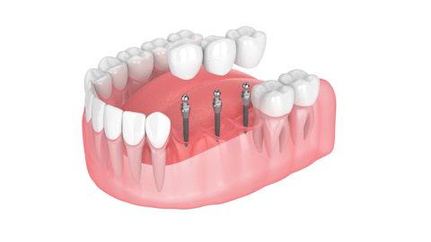 Puentes Dentales vs. Dentaduras Parciales en Melbourne, FL | Mini Implantes