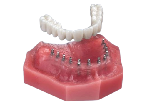 Roundhouse Bridge in Melbourne FL | Mini Implant Dentures