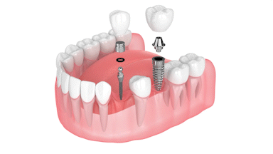 Mini Implantes vs Implantes Regulares | Dientes Perdidos en Melbourne, FL