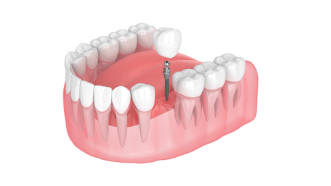 Implantes Dentales Asequibles en Melbourne, FL | Consultas Gratuitas