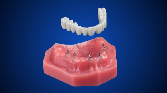 Snap-On Denture | Mini Dental Implants in Melbourne, FL