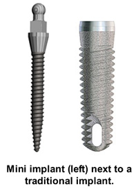 Snap-In Dentures in Melbourne, FL | Ask Us About Mini Implants!