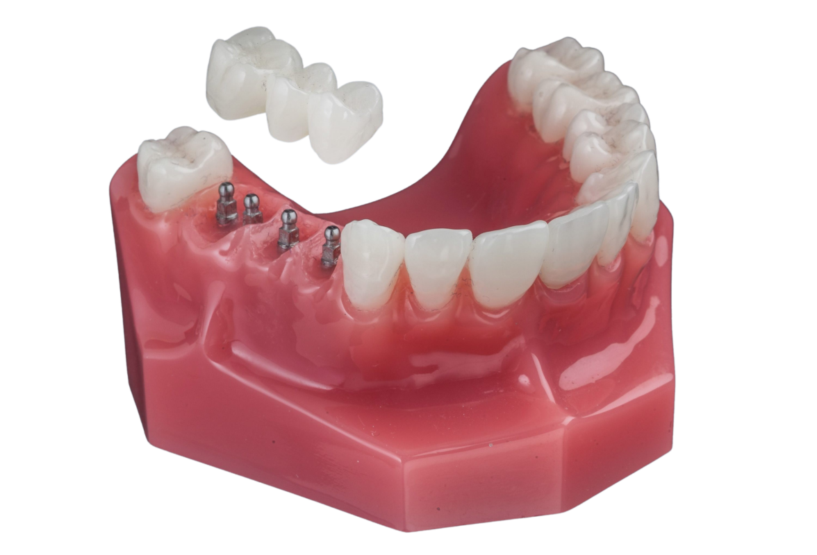 Dental Bridges vs. Implants in Melbourne, FL | Mini Dental Implants