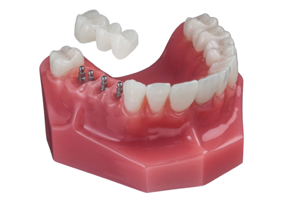 Puentes Dentales vs Implantes en Melbourne, FL | Mini Implantes Dentales