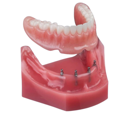 ¡Snap In Denture en Melbourne FL | Reserve su consulta gratis!