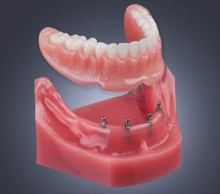 Snap In Dientes en Melbourne, FL | Arco Completo Mini Implantes Dentales