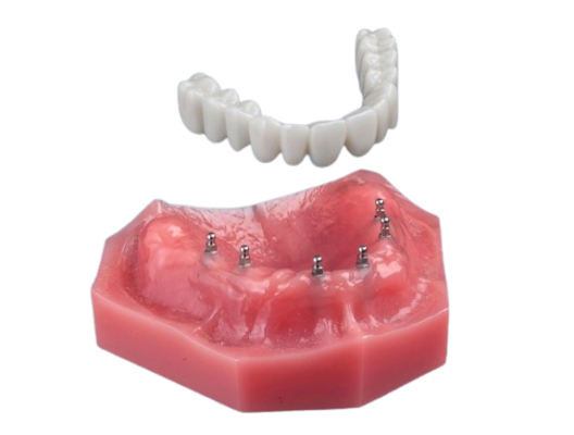Dentaduras Semi Permanentes en Melbourne, FL | ¡Consultas Gratis!
