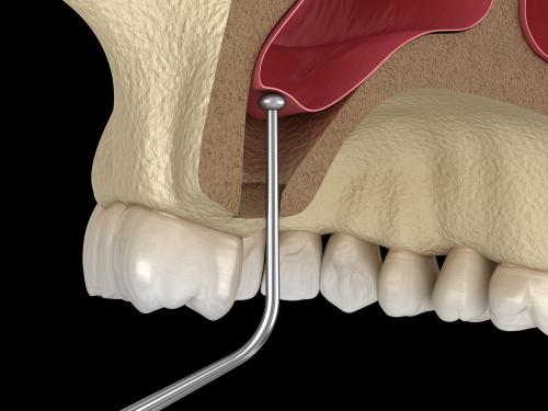 Elevación de seno explicada | Mini Implantes Dentales en Melbourne, FL