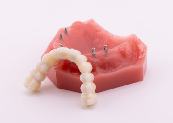 Dentaduras permanentes en Melbourne, FL | Reserve una consulta gratuita