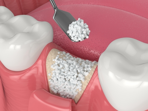 Dental Bone Graft Melbourne, FL | Book a Free Consltation Today