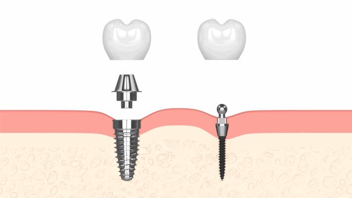 Melbourne Implant Dentist | Affordable Tooth Repalcement Options