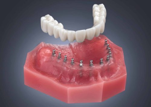 Full Mouth Dental Implants Melbourne FL | Affordable Denture Care