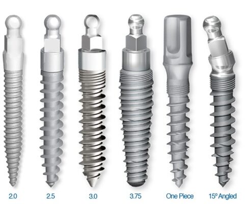 One-Piece Dental Implants in Melbourne, FL | Book a Consultation!