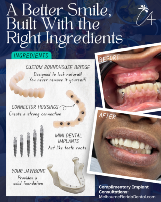 Implantes dentales para toda la boca en Melbourne, FL | Puente Roundhouse con miniimplantes
