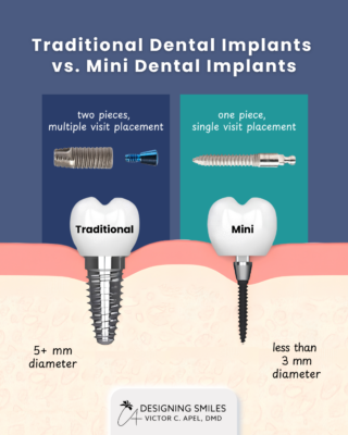 Mini Dental Implants in Orlando FL | Mini Implant vs. Traditional Implant