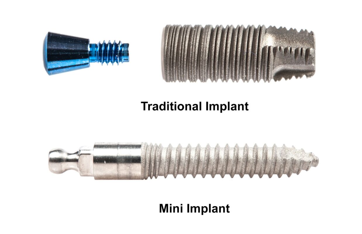 Mini Implants vs Regular Implants | Find Your Fit in Melbourne, FL