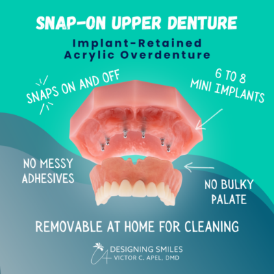 Snap On Dental Implants | Affordable Dentures in Melbourne, FL | Mini Dental Implants