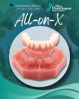 Todo sobre los implantes dentales X en Melbourne, Florida | Prótesis dental soportada por implantes