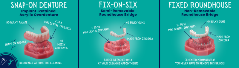 Implant Dentures Review | Implant Denture Options in Melbourne, FL