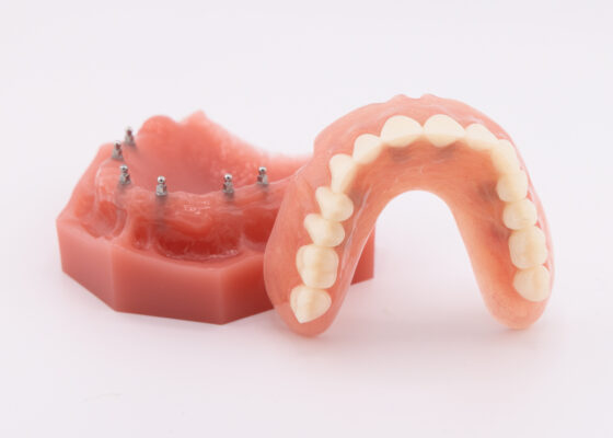 Costo de las dentaduras postizas con miniimplantes en Melbourne, FL | Dentaduras postizas a presión con miniimplantes dentales