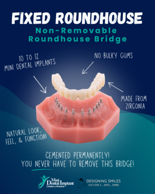 Palateless Dentures in Melbourne, FL |Dental Financing Available | Fixed Roundhouse Bridge