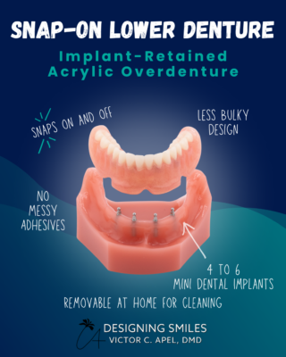 Snap-On Dentures in Palm Bay, FL | Book a Complimentart Consult